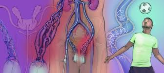 Image result for Varicocele