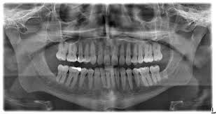 Should We Get Dental X Rays Kelly The Kitchen Kop Radiography Dental Dentistry