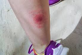 Borelioza przenoszona jest przez kleszcze, które są nosicielami bakterii borrelia burgdorferi wywołującej tę chorobę. Objawy Boreliozy Infozdrowie24 Pl
