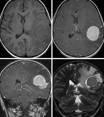 Pleomorphic xanthoastrocytomas are almost invariably (98%) located supratentorially, typically located superficially (peripherally) abutting the leptomeninges, involving the cortex and overlying leptomeninges but actual. Pleomorphic Xanthoastrocytoma The Neurosurgical Atlas