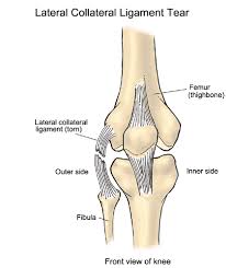 From 0° to 30° of knee flexion, the fcl is the main structure preventing varus opening of the knee joint. Fcl Tear Posterolateral Corner Jonwatsonmd