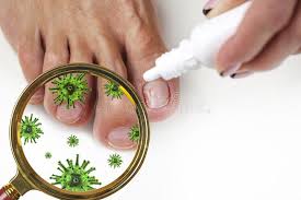 Onychomycosis is a fungal infection usually caused by a special type of fungus known as a dermatophyte. 589 Skin Fungus Nail Female Foot Photos Free Royalty Free Stock Photos From Dreamstime