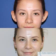 Upper blepharoplasty creates a more awake, focused appearance to make your  energetic best. Removal of the excess skin (and perhaps a touch of medial  fat) under local anesthesia only. With only one