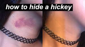 How To Get Rid Of A Hickey Fast – The Instant Remedies -Blogsikka