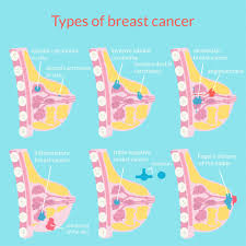 Hormone therapy for breast cancer. Breast Cancer Dr Erick Fuentes Oncoplastic Breast Surgeon