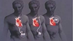 Desfibrilador interno o dai (desfibrilador automático implantable), es aquel que se implanta en la persona de la misma forma que un marcapasos. Treinta Anos Resucitando Personas
