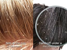 Image result for lice vs nits