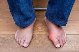 Image result for gout