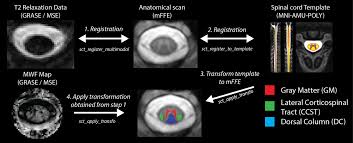 Introduced decades ago, mffe did not find practical applications. Rapid Myelin Water Imaging In Human Cervical Spinal Cord Ljungberg 2017 Magnetic Resonance In Medicine Wiley Online Library