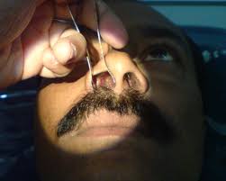 These polyps vary in size, and they can grow singly or in if the symptoms of nasal polyp seem to ba related to an allergic reaction, it will probably help to avoid the allergen that triggers the reaction. Nasal Polyps Canada Pdf Ppt Case Reports Symptoms Treatment