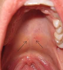 These tiny palatal cysts are harmless. Is It Bad That I Have A Couple Tiny Holes In The Roof Of My Mouth That I Can Suck Air Through Quora
