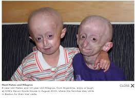 Image result for progeria case in bihar