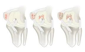 This causes the medial femoral condyle to also be displaced posteriorly, resulting in external rotation of the tibia. Chondromalacia Summit Orthopedics