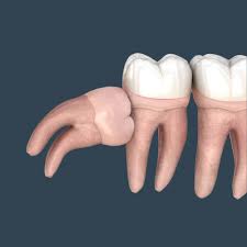 Wisdom Teeth Removal Orland Park Il Premier Dental Implant Center