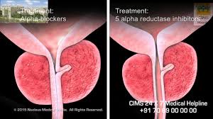 Benign Prostatic Hyperplasia Hindi Cims Hospital Youtube