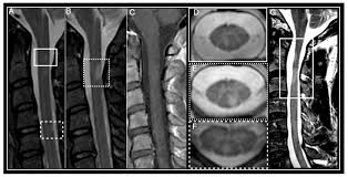 Image result for Myelitis
