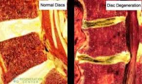 Can Stem Cells Help Reverse Degenerative Disc Disease