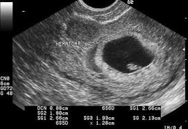 Pin De Jessica Lachi En Curriculum Hematomas Imagenes De Ultrasonido Embarazo
