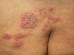 Die gürtelrose ist eine infektionskrankheit. Gurtelrose Herpes Zoster Deximed