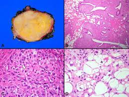 The lump will feel smooth to the touch. Malignant Phyllodes Tumor Of The Breast With Liposarcomatous Differentiation A Case Report With Imaging Findings Sciencedirect