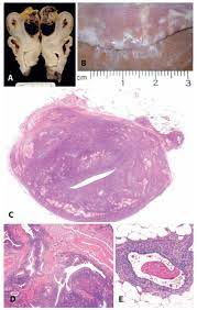 By better understanding the polymorphic appearance of endometriosis, it will improve our diagnostic potential without having to rely on pathology. Endometriosis And Adenomyosis A And B Variation In The Gross Download Scientific Diagram