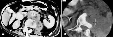 A procedure that makes a series of detailed pictures of areas inside the body, taken from different angles. Ct Atlas Glowm