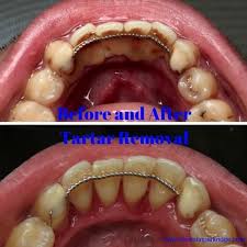 How to get hard plaque off teeth. Smile Gallery Dentistry Remove Tartar Tartar Removal