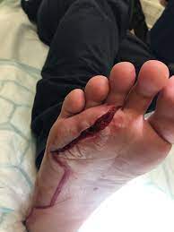 My Foot When I Stepped On Piece Of Glass On My Way To Swimming Medicalgore