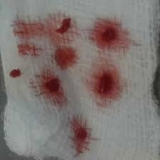 Clinical view of application of 2 mm of white MTA mark Angelus®