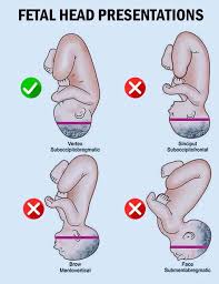 Image result for Manual Rotation in Occipitoposterior Presentation