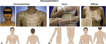 Image result for Diffuse Hyperpigmentation