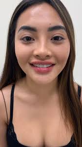 Lip Augmentation by Lucy using RHA Redensity 👄, #LipAugmentation #RHA  #BeforeAndAfter #LAInjector #RHARedensity #Transformation