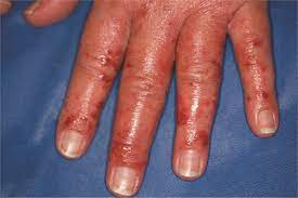 Client Of The Month The Hyper Sensitive Allergic Contact Dermatitis Allergic Dermatitis Contact Dermatitis