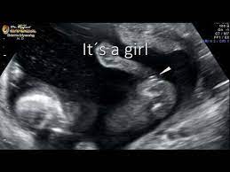 The nuchal translucency scan (also called the nt scan) uses ultrasound to assess your what do the nt test results mean? Dating Scans Babycenter Australia