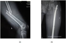 paediatric fem shaft fractures