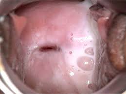 Image result for Friable Cervix