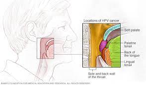 Pain while chewing, sores on the neck that don't heal, difficulty swallowing, or hoarseness. Throat Cancer Sparrow