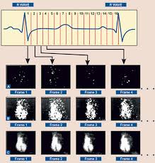 Image result for Nuclear Ventriculogram