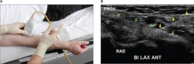 Image result for Biceps Tendon Injection