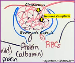 Nephrotic Syndrome Vs Glomerulonephritis Nclex Review