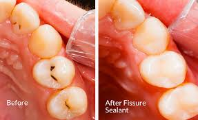 After sealant has been applied it keeps those bits of food out and stops bacteria and acid from settling on your teeth—just like a raincoat keeps you clean and how are sealants applied? Dental Sealants Rrdch