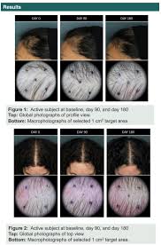 M aca root, an ancient crop grown in the andes mountains that has become popular among women searching for supplements for hair growth. Nutrafol Targets Hair Growth In Menopausal Women