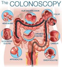 Consideration Of Colonoscopy Revolution Pharmd Gastroenterology Colonoscopy Nurse