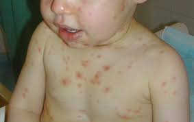 Image result for chicken pox