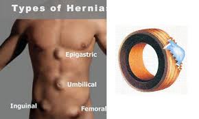 Image result for Hernia Reduction
