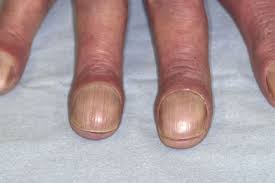 Image result for Clubbing nails feet