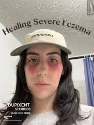 Effective Strategies for Healing Severe Eczema