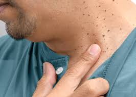 Image result for Skin Tag
