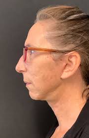 Face Lift with Dr. Joseph Spaniol