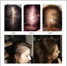 However, chemical processing, including hair dyeing, permanent waving, and hair straightening, can encourage further hair loss through breakage. Images Of Hair Loss In Patients With Androgenetic Alopecia Syndrome Download Scientific Diagram